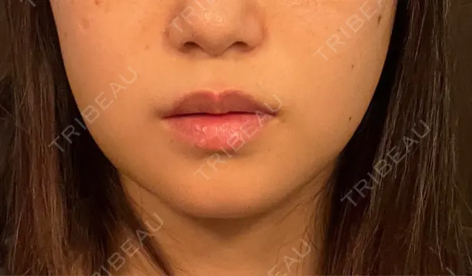 糸リフト / バッカルファット除去 / 脂肪吸引（顔） / ヒアルロン酸注入（鼻） / ボトックス（エラ・小顔） RIVER CLINIC（リバークリニック） DAY 6 メイン用