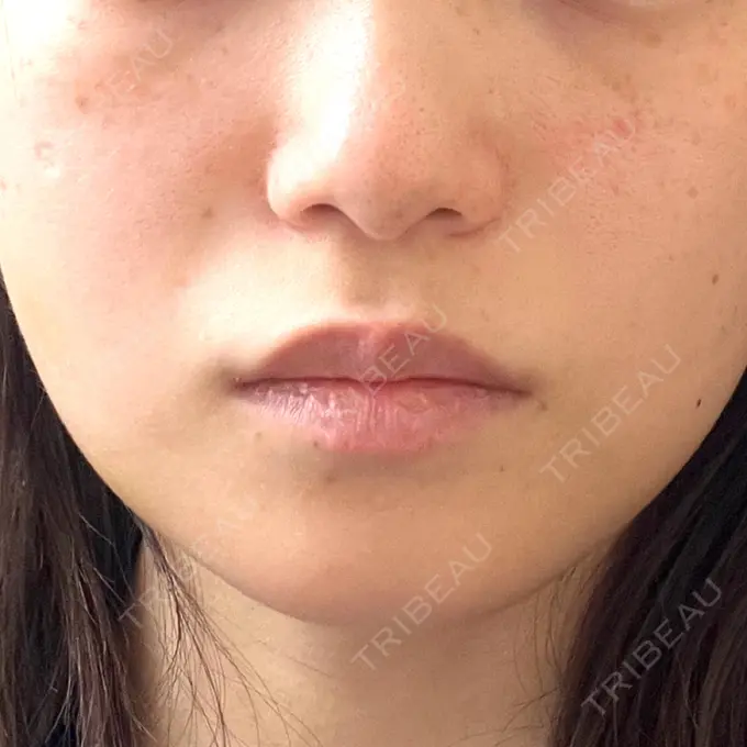 糸リフト / バッカルファット除去 / 脂肪吸引（顔） / ヒアルロン酸注入（鼻） / ボトックス（エラ・小顔） RIVER CLINIC（リバークリニック） DAY 7 メイン用