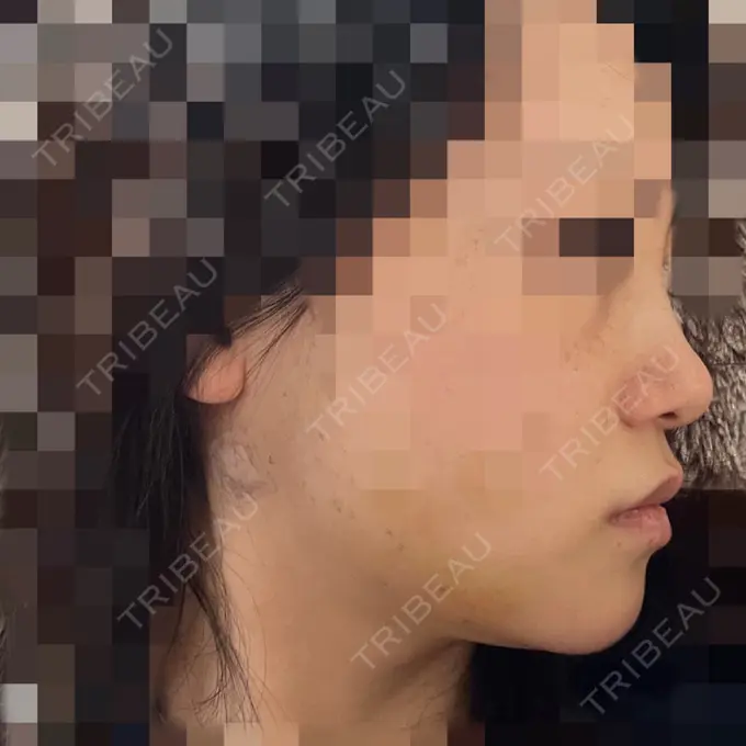 糸リフト / バッカルファット除去 / 脂肪吸引（顔） / ヒアルロン酸注入（鼻） / ボトックス（エラ・小顔） RIVER CLINIC（リバークリニック） DAY 7 メイン用