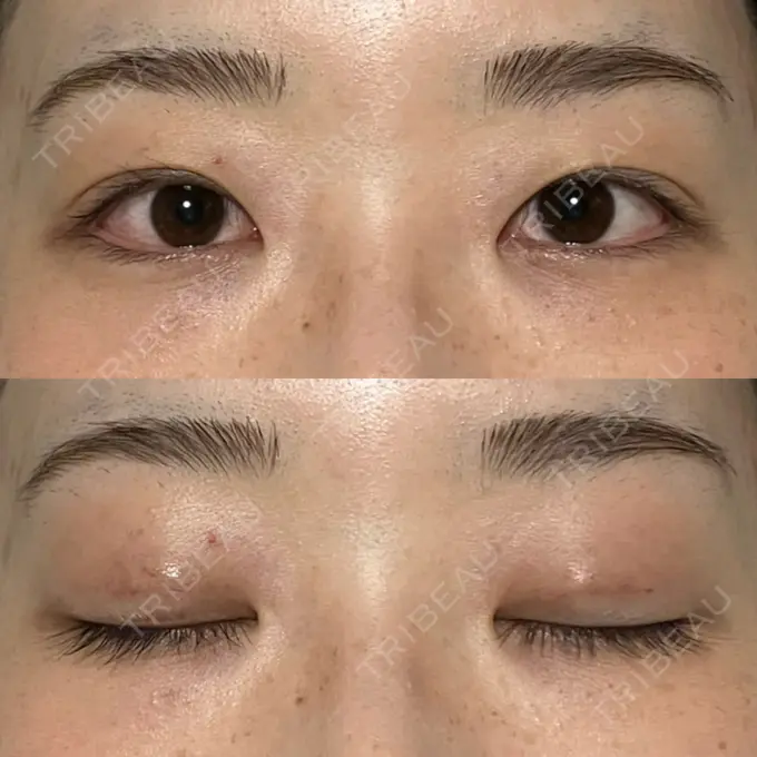 二重埋没 水の森美容クリニック 名古屋院 DAY 3 メイン用