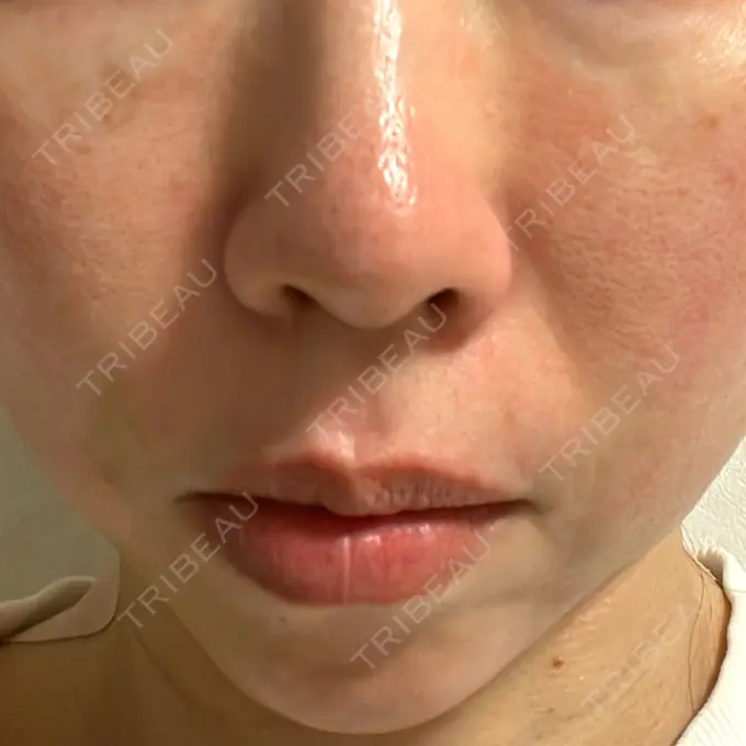 ピコレーザートーニング（美白・肝斑） / ピコフラクショナルレーザー（毛穴・ニキビ跡） G MEDICAL ART クリニック 新宿院 DAY 0 メイン用