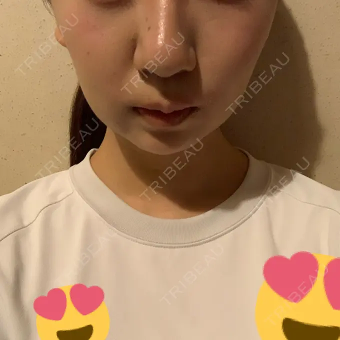 糸リフト / バッカルファット除去 / 脂肪吸引（顔） RIVER CLINIC（リバークリニック） DAY 11 メイン用