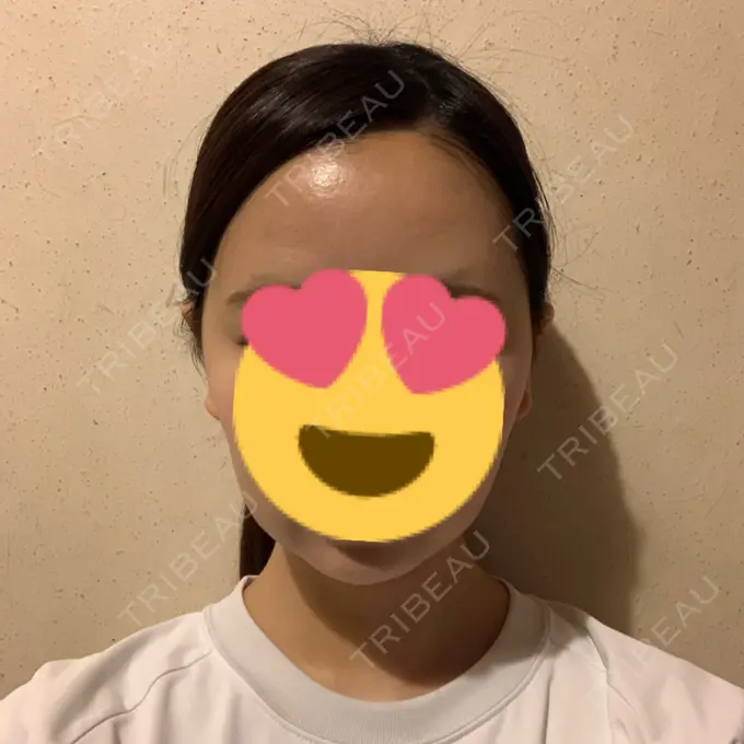 糸リフト / バッカルファット除去 / 脂肪吸引（顔） RIVER CLINIC（リバークリニック） DAY 11 メイン用