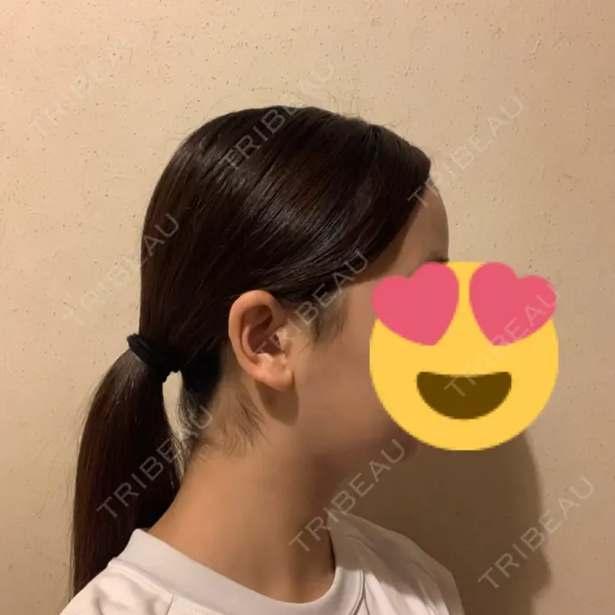 糸リフト / バッカルファット除去 / 脂肪吸引（顔） RIVER CLINIC（リバークリニック） DAY 11 メイン用