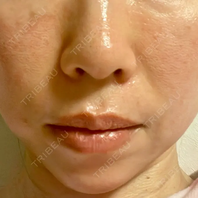 ピコレーザートーニング（美白・肝斑） / ピコフラクショナルレーザー（毛穴・ニキビ跡） G MEDICAL ART クリニック 新宿院 DAY 2 メイン用