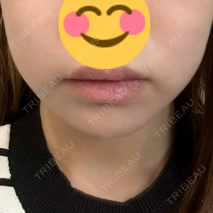 ボトックス（エラ・小顔） CLINIC W DAY 2 メイン用