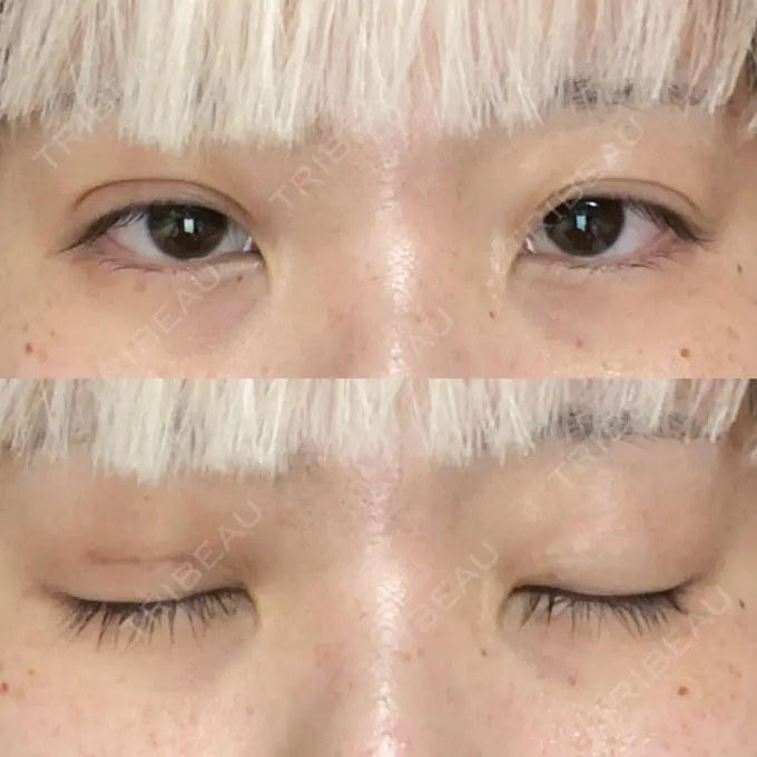 二重埋没 東京シンデレラ美容外科 池袋院 DAY 467 メイン用