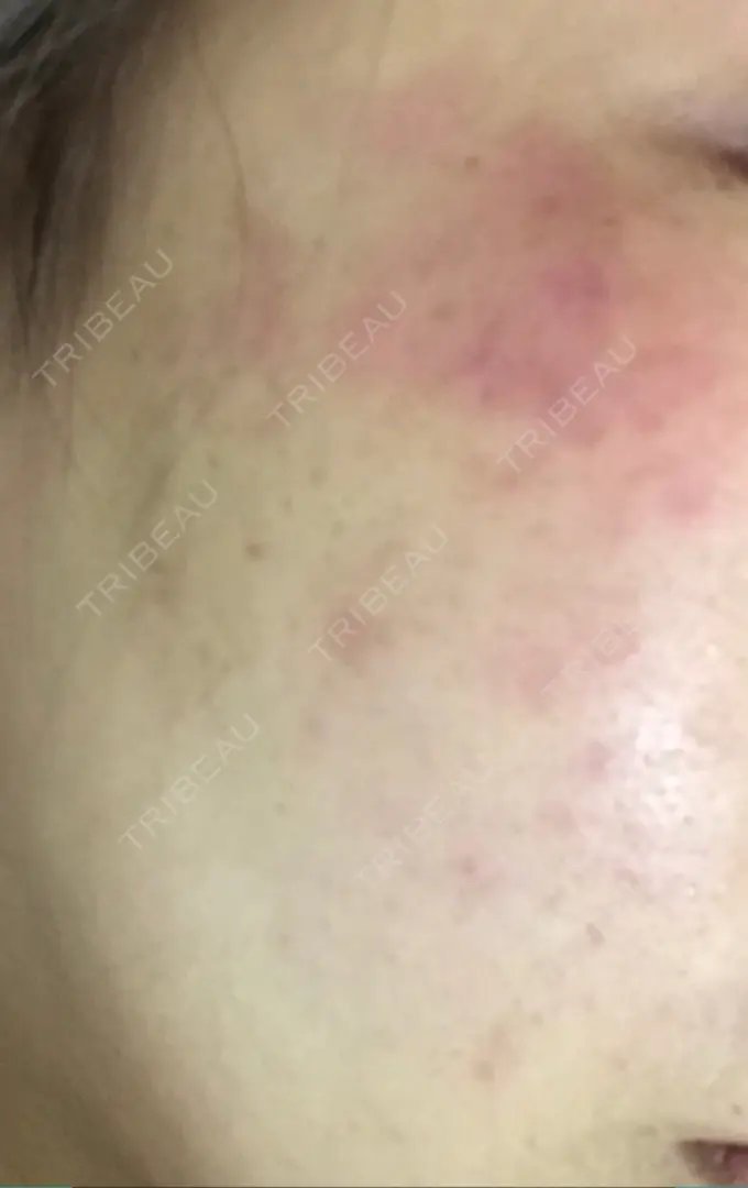 シミ取りレーザー 仁愛クリニック DAY 11 メイン用