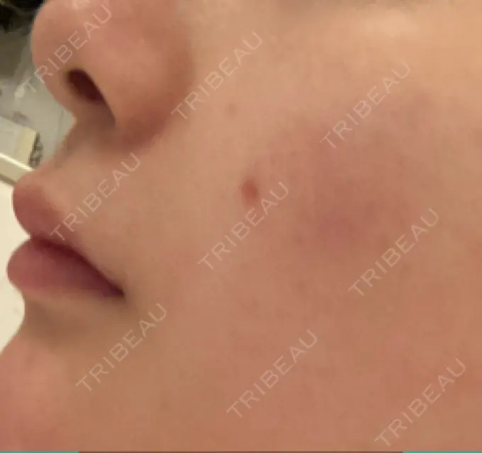 ほくろ・いぼ切除（肌） バログ医院 江南院 DAY 18 メイン用