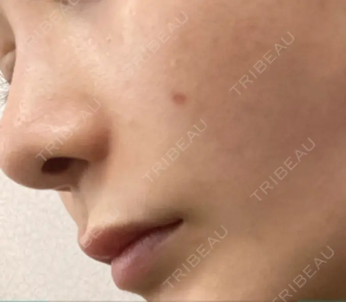 ほくろ・いぼ切除（肌） バログ医院 江南院 DAY 22 メイン用