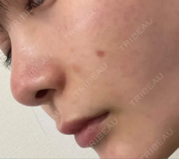 ほくろ・いぼ切除（肌） バログ医院 江南院 DAY 32 メイン用