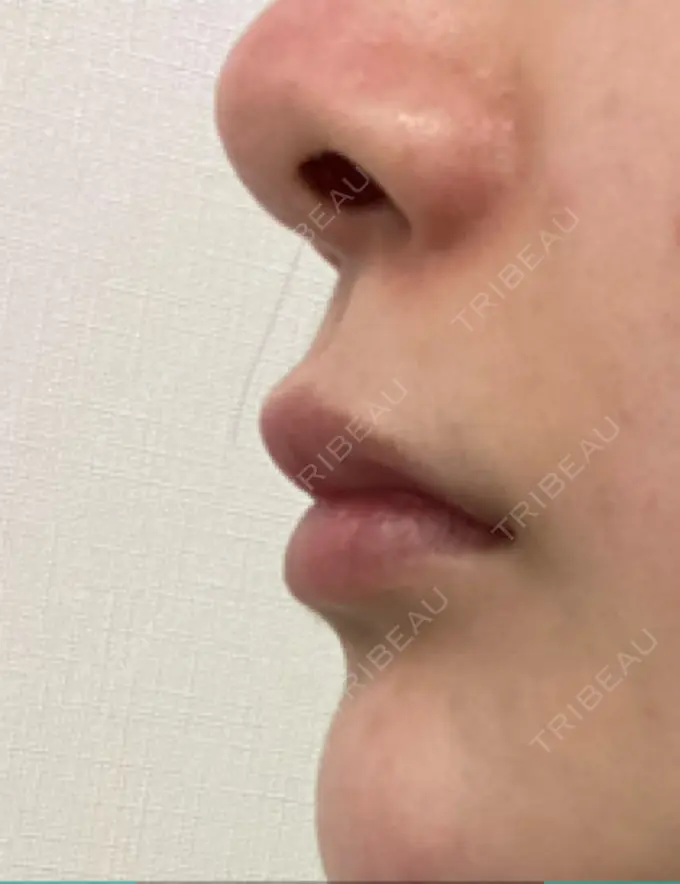 ヒアルロン酸注入（鼻翼基部） バログ医院 江南院 DAY 33 メイン用