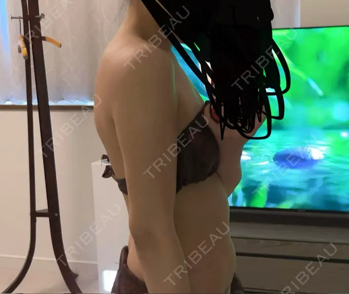 脂肪吸引（二の腕） Mods Clinic（モッズクリニック） 名古屋院 DAY 31 メイン用