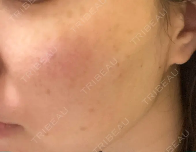 エレクトロポレーション / 毛穴洗浄（ハイドラフェイシャルなど） / 光治療（フォトフェイシャルなど） B-LINE CLINIC 池袋院 AFTER メイン用