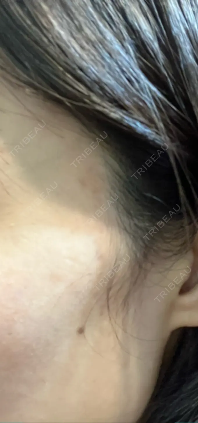 ルビーレーザー S-Laboクリニック 渋谷院 DAY 14 メイン用