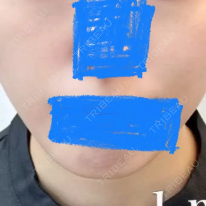 脂肪吸引（顔） yuzawa clinic AFTER メイン用