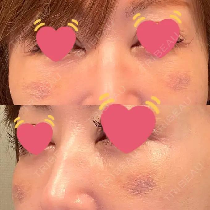 クマ治療 / 下まぶたたるみ取り / 脂肪注入（目の下） / ヒアルロン酸溶解 X CLINIC 大阪院 DAY 8 メイン用