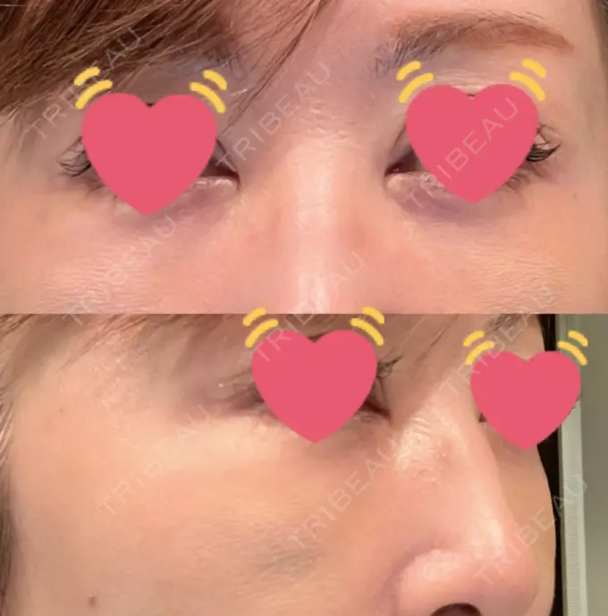 クマ治療 / 下まぶたたるみ取り / 脂肪注入（目の下） / ヒアルロン酸溶解 X CLINIC 大阪院 DAY 8 メイン用