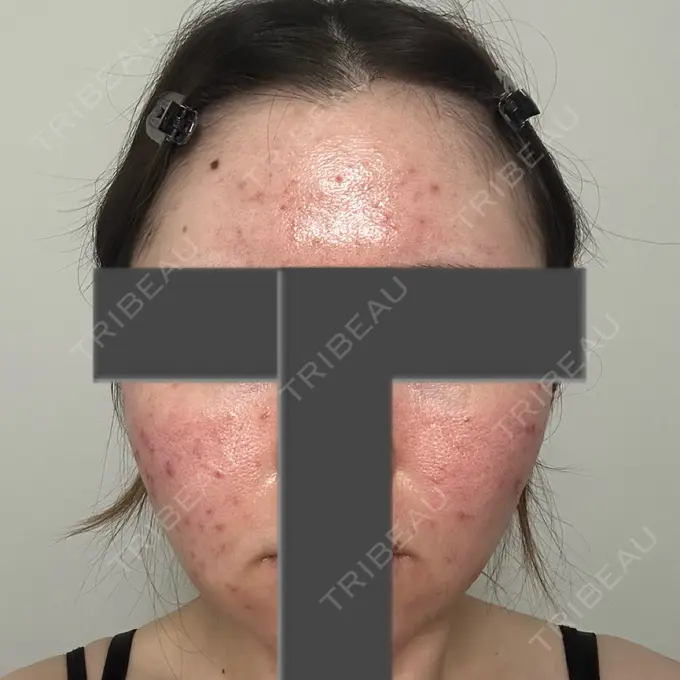 ニードルRF（ポテンツァなど） 東京美容外科 池袋院 DAY 0 メイン用