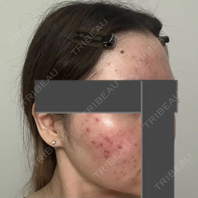 ニードルRF（ポテンツァなど） 東京美容外科 池袋院 DAY 0 メイン用