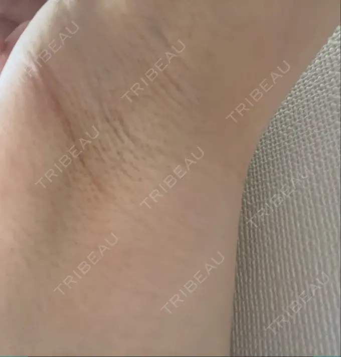 脂肪注入（額） / 豊胸（シリコン＋脂肪併用） / 美容点滴・美容注射（美肌） / ワキ汗治療（ボトックス） MYCLI【マイクリ】東京・恵比寿院 DAY 44 メイン用