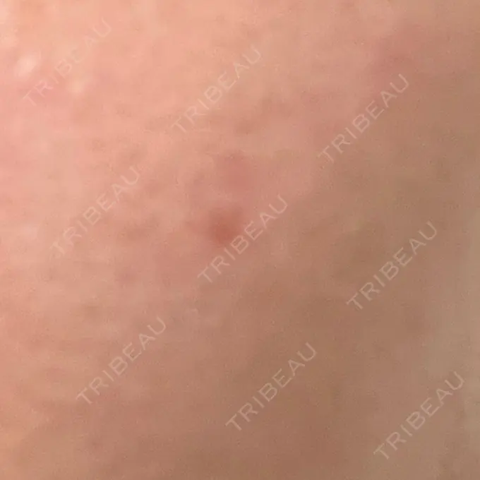 ほくろ・いぼ除去レーザー（肌） リッツ美容外科 大阪院 AFTER メイン用