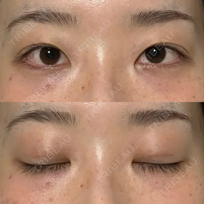 二重埋没 水の森美容クリニック 名古屋院 DAY 9 メイン用