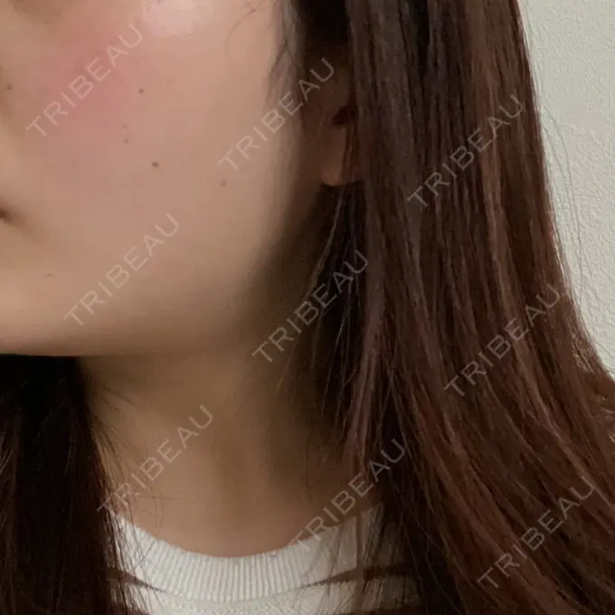 ボトックス（あご） / ボトックス（エラ・小顔） TCB東京中央美容外科 仙台駅前院 AFTER メイン用