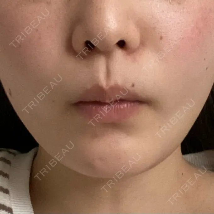 ボトックス（あご） / ボトックス（エラ・小顔） TCB東京中央美容外科 仙台駅前院 DAY 1 メイン用