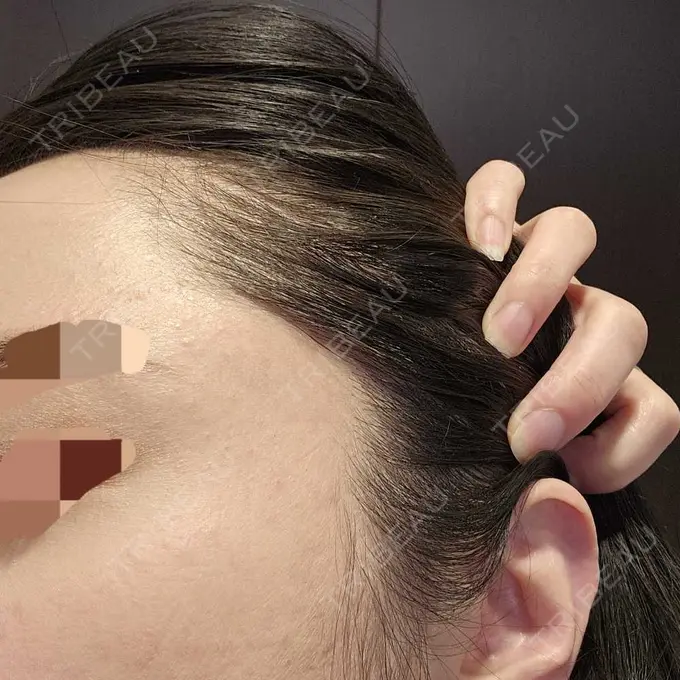 ニードルRF（ポテンツァなど） / ポテンツァ A CLINIC（エークリニック） 仙台院 DAY 16 メイン用