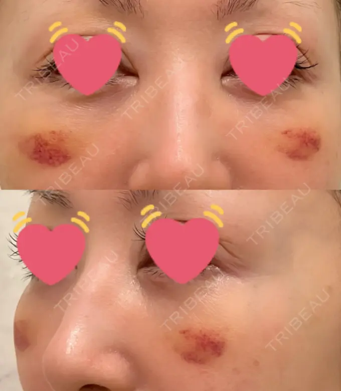 クマ治療 / 下まぶたたるみ取り / 脂肪注入（目の下） / ヒアルロン酸溶解 X CLINIC 大阪院 DAY 10 メイン用