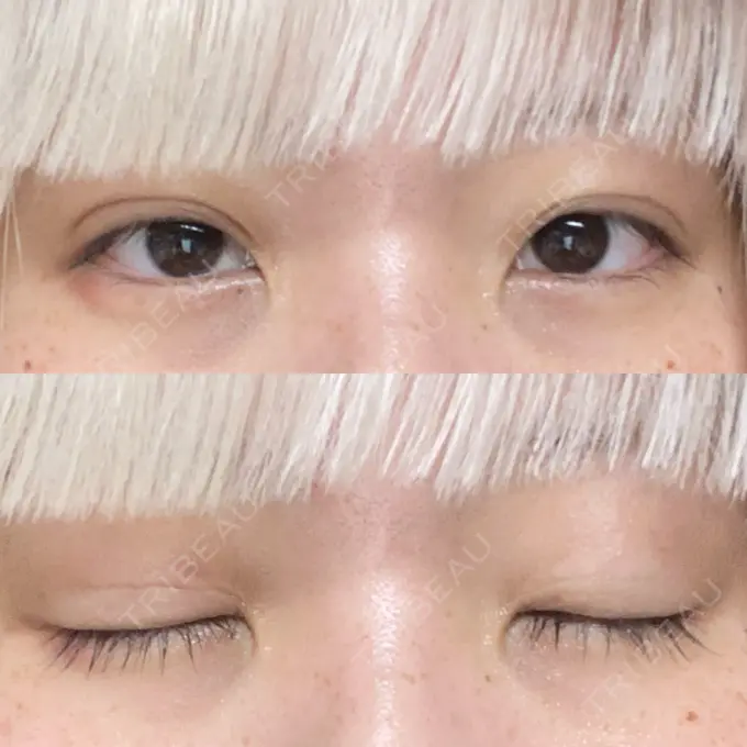 二重埋没 東京シンデレラ美容外科 池袋院 DAY 473 メイン用