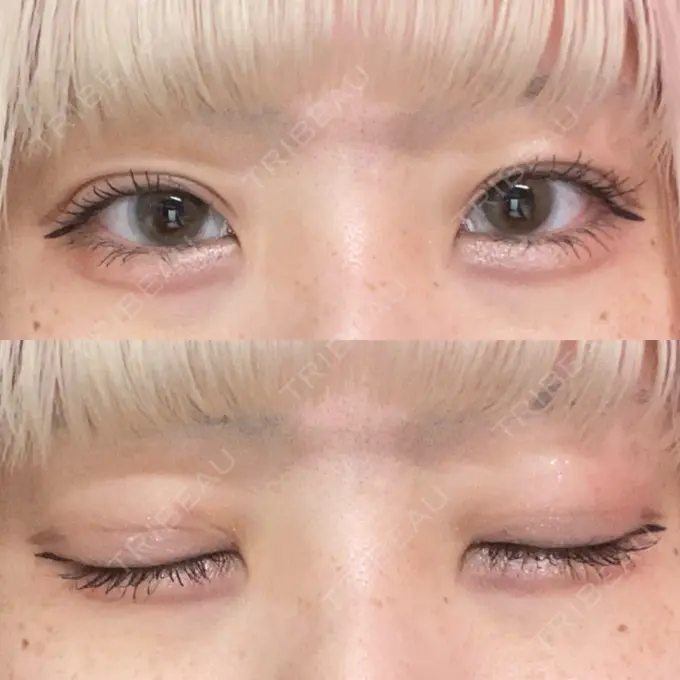 二重埋没 東京シンデレラ美容外科 池袋院 DAY 473 メイン用