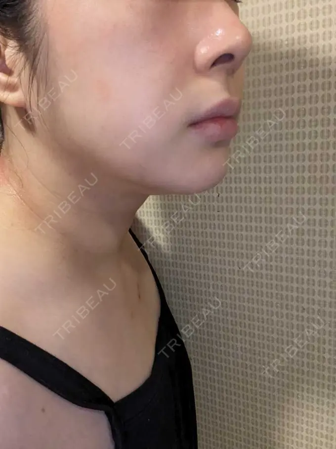 エレクトロポレーション / ルメッカ B-LINE CLINIC 池袋院 DAY 4 メイン用