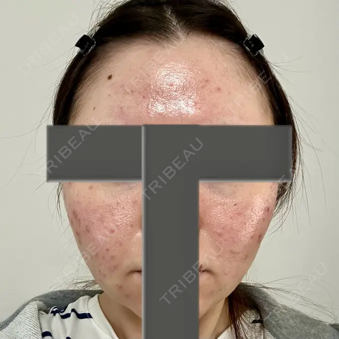 ニードルRF（ポテンツァなど） 東京美容外科 池袋院 DAY 3 メイン用