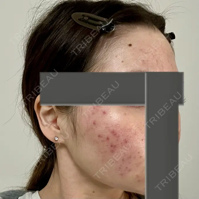 ニードルRF（ポテンツァなど） 東京美容外科 池袋院 DAY 3 メイン用