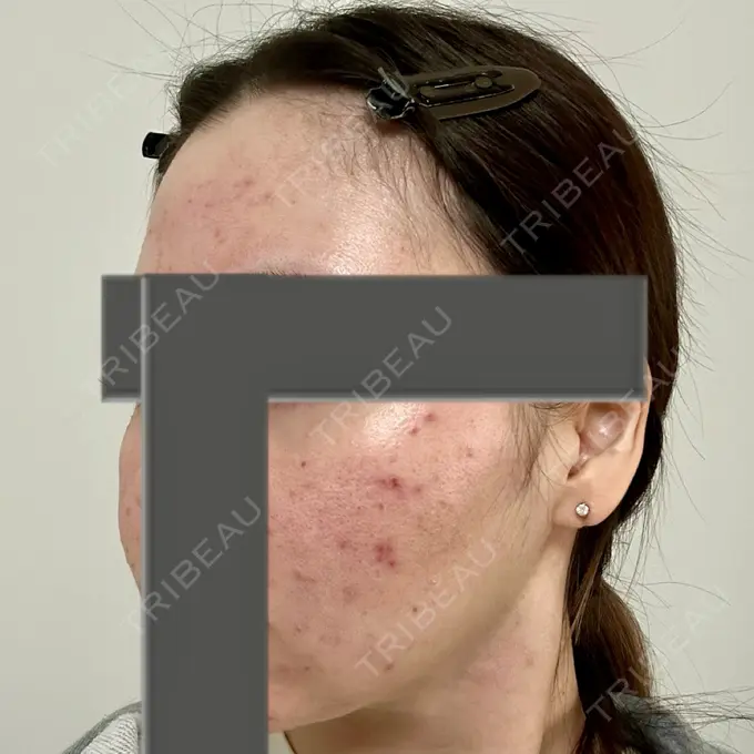 ニードルRF（ポテンツァなど） 東京美容外科 池袋院 DAY 3 メイン用