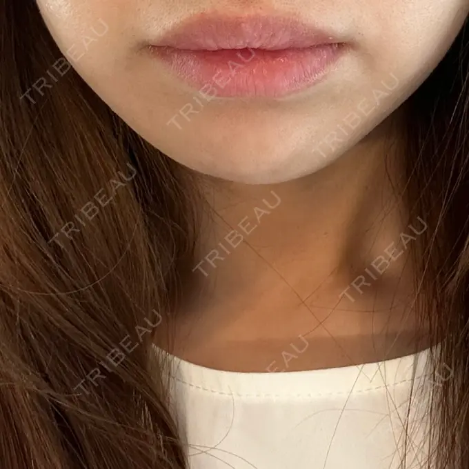 ボトックス（エラ・小顔） CLINIC W DAY 6 メイン用