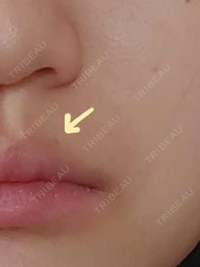 ほくろ・いぼ切除（肌） / ボトックス（エラ・小顔） 品川美容外科 渋谷院（※品川スキンクリニック提携） DAY 50 メイン用