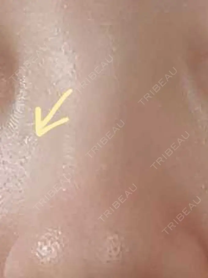 ほくろ・いぼ切除（肌） / ボトックス（エラ・小顔） 品川美容外科 渋谷院（※品川スキンクリニック提携） DAY 50 メイン用