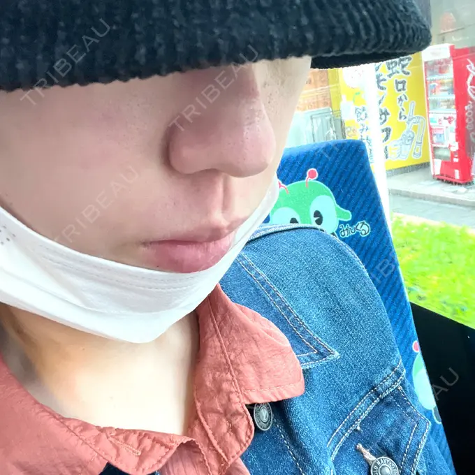 エレクトロポレーション / 毛穴洗浄（ハイドラフェイシャルなど） / ヴェルヴェットスキン ミニマムスキンクリニック池袋 AFTER メイン用