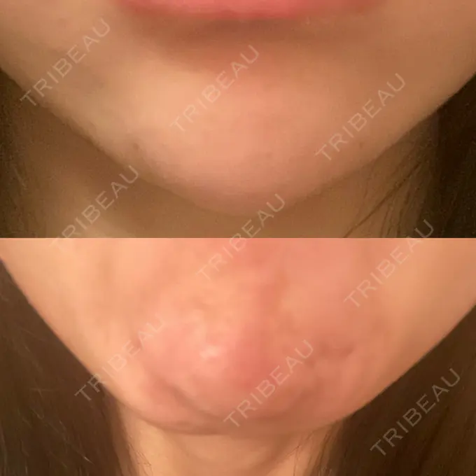 ボトックス（あご） 湘南美容クリニック 金山院 DAY 0 メイン用