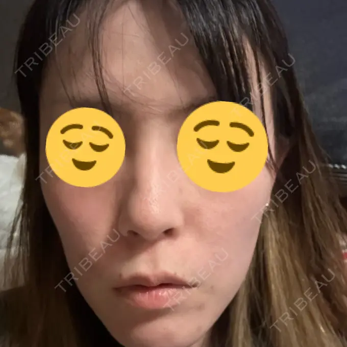 ダーマペン ライズワン美容皮膚科クリニック DAY 8 メイン用