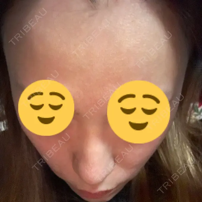 ダーマペン ライズワン美容皮膚科クリニック DAY 8 メイン用