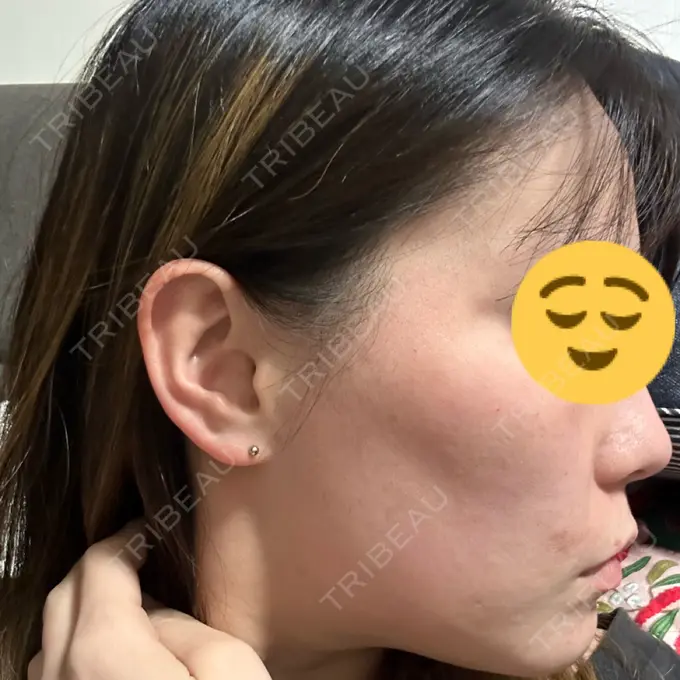 ダーマペン ライズワン美容皮膚科クリニック DAY 8 メイン用