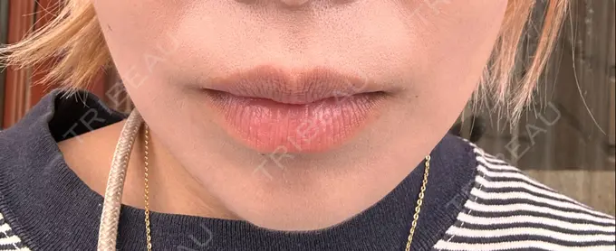 ボトックス（エラ・小顔） / ボトックス（口角） / ボトックス（肩） 日比谷セントラルクリニック DAY 6 メイン用