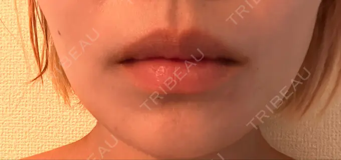 ボトックス（エラ・小顔） / ボトックス（口角） / ボトックス（肩） 日比谷セントラルクリニック DAY 8 メイン用