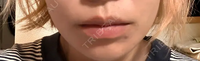 ボトックス（エラ・小顔） / ボトックス（口角） / ボトックス（肩） 日比谷セントラルクリニック AFTER メイン用