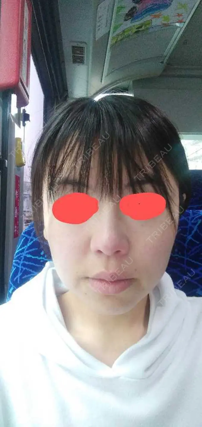 ボトックス（エラ・小顔） TCB東京中央美容外科 福岡博多院 DAY 68 メイン用