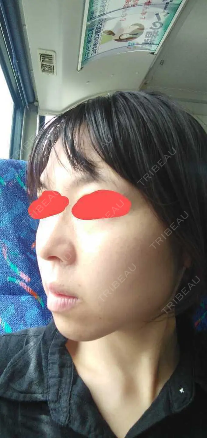 ボトックス（エラ・小顔） TCB東京中央美容外科 福岡博多院 AFTER メイン用